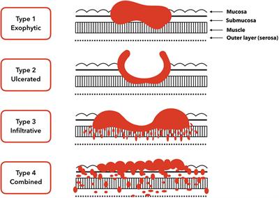 Eradication of Helicobacter pylori and Gastric Cancer: A Controversial Relationship